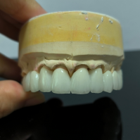 China Dental Lab Custom Made Implant Teeth Full Arch Zirconia Crown with Titanium Bar Bridge