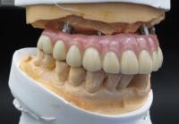 Dental Laboratory Overdenture Services | Myy Dental Lab